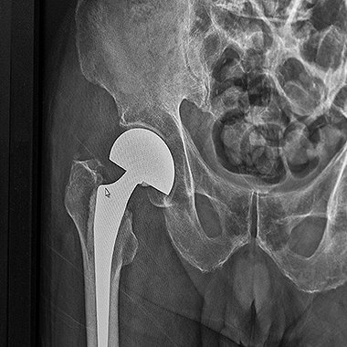 W mojej praktyce stosuję nowoczesny, małoinwazyjny dostęp przedni – technikę MIS DAA (Minimally Invasive Surgery – Direct Anterior Approach)