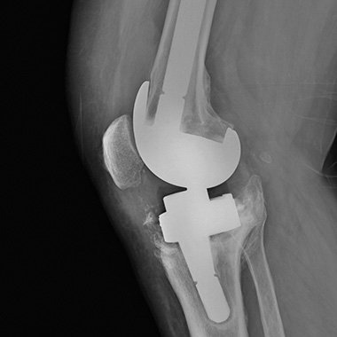 W mojej praktyce wykonuję endoprotezoplastykę stawu  kolanowego, stosując zarówno protezy całkowite, jak  i jednoprzedziałowe (częściowe). 